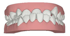 Invisalign